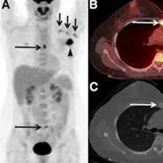 The Role Of PET Scan In Staging Of Cancer